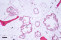 Figure 6. . Contents of a cyst-like bone lesion.