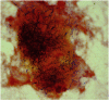 Case study 2 (Figure). Rare aggregate of branching, Gram-positive rods, characteristic of Nocardia and Actinomyces.