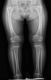 Figure 1. . Standing lower-limb radiograph of a girl age four years with Schmid metaphyseal chondrodysplasia.