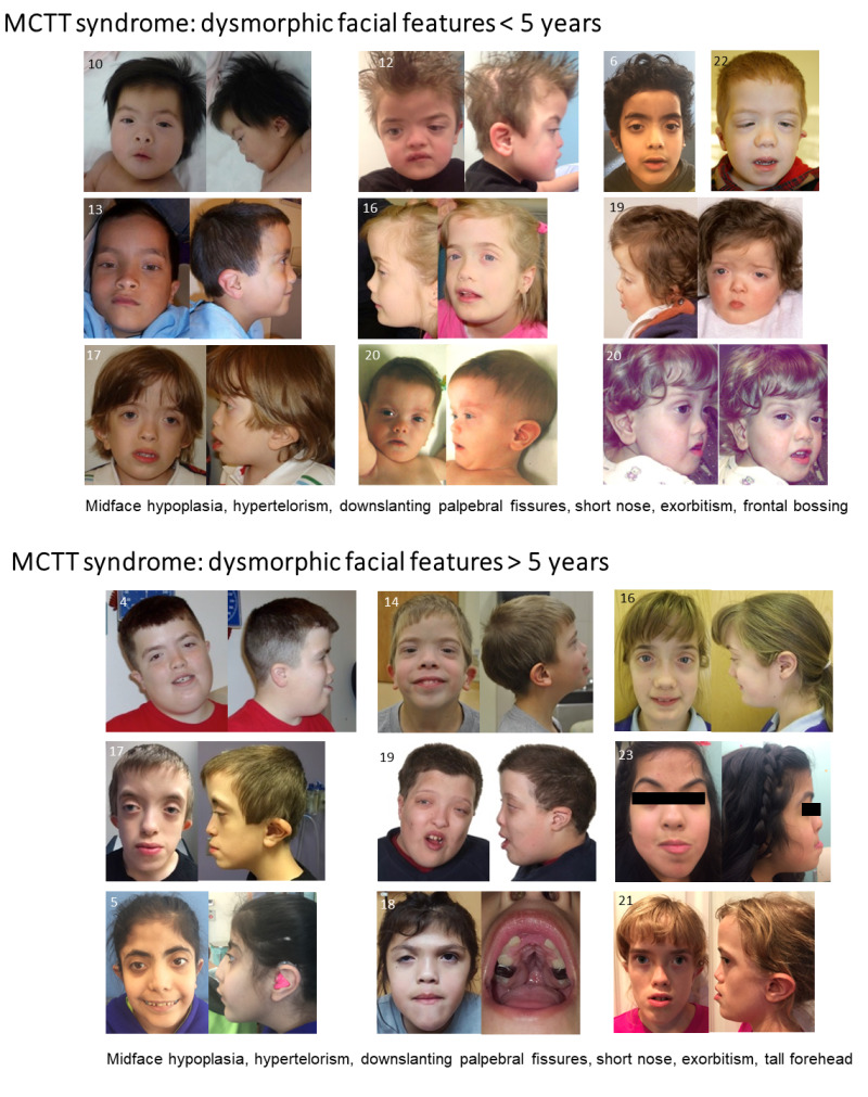 Figure 1. . Facial features of individuals with C-terminal truncating variants in MN1, illustrating how features evolve from before to after age five years.