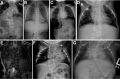 Figure 3. . individuals with HES7-related SCDO compared to an unaffected individual.