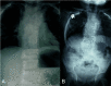 Figure 8. . Radiographs of a child with MESP2-related SCDO.